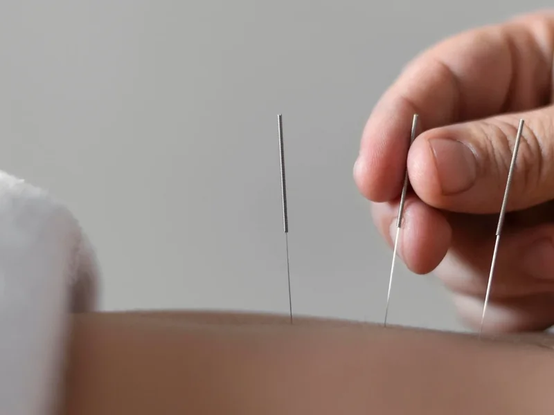 Dry needling treatment
