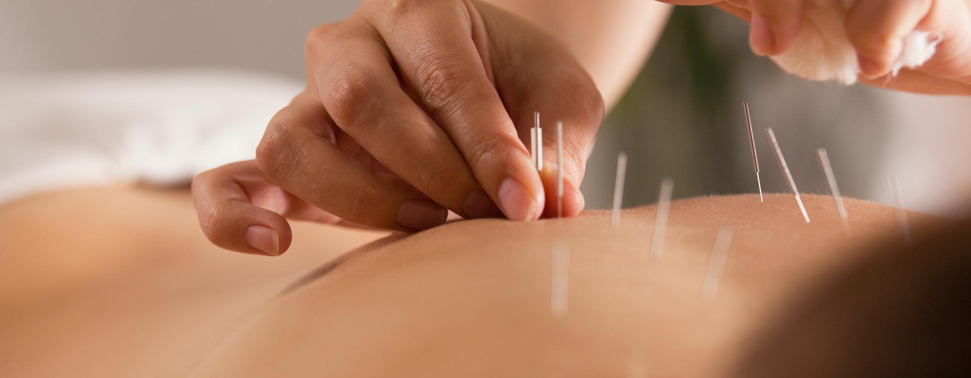 dry needling