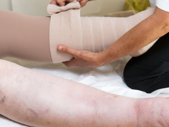 Lymphedema